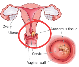 Cervical Cancer